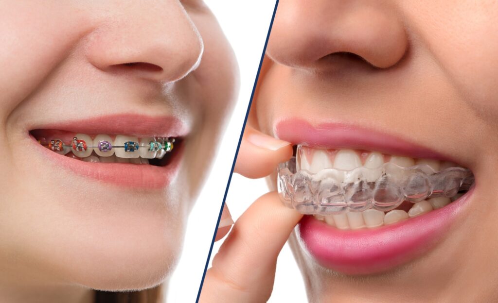 Invisalign vs. Traditional Braces - Making the Right Choice with Best Orthodontist in Kothrud