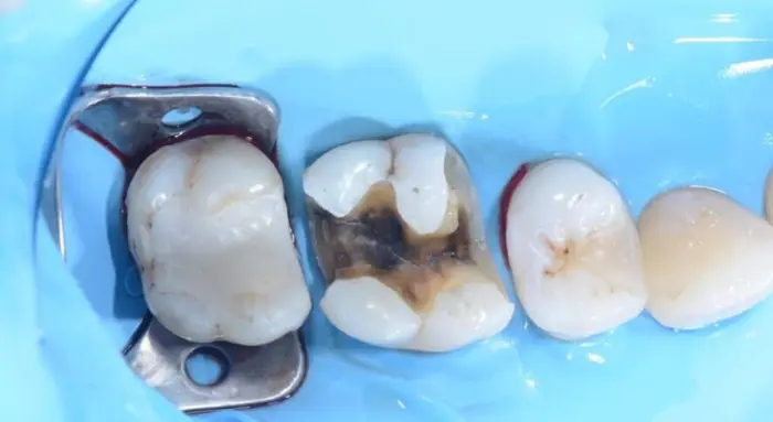 Class 2 Cavities