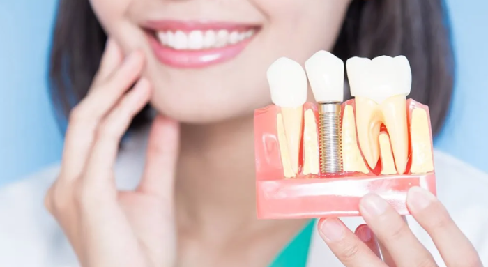Dental Implants