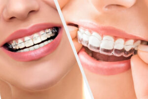 Invisalign Over Traditional Braces