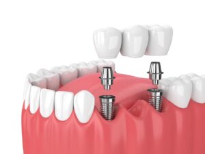 Dental Implants In Pune