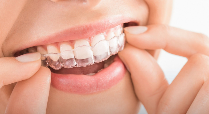 Invisalign in Pune