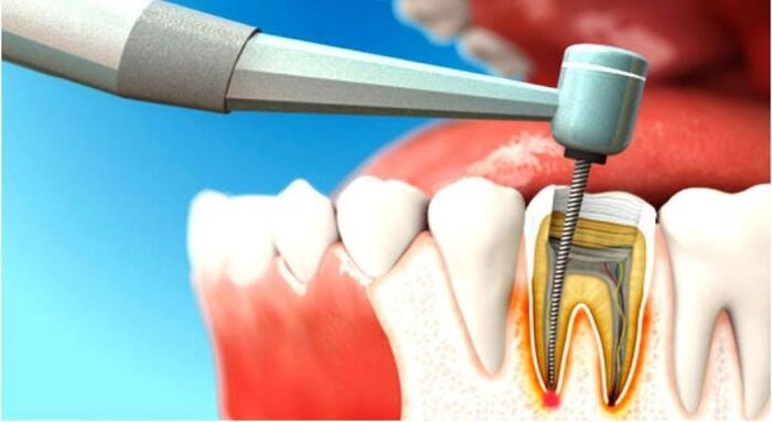 Root Canal Treatment in Pune: When Is It Absolutely Necessary?
