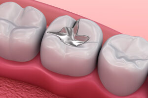 Root Canal Treatment near me