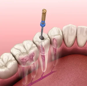 Root Canal Treatment in Pune