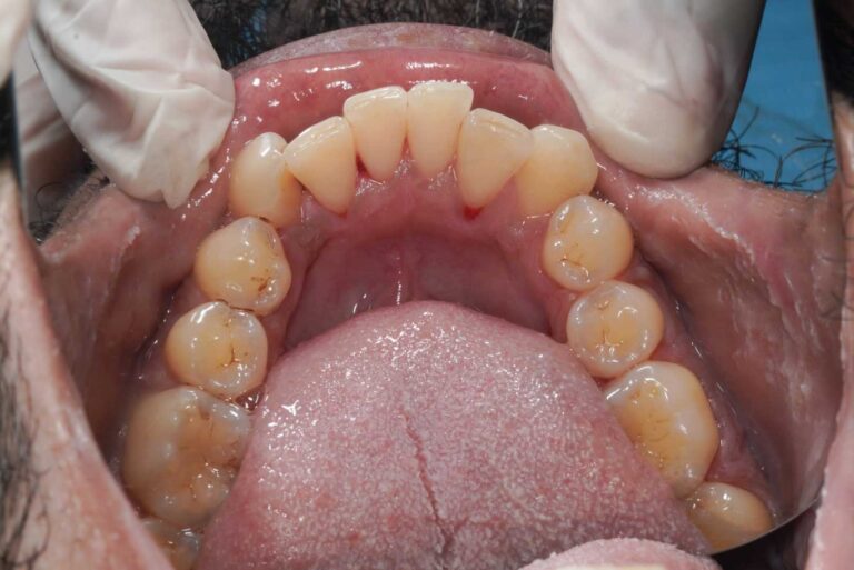 scaling-and-polishing-2-after