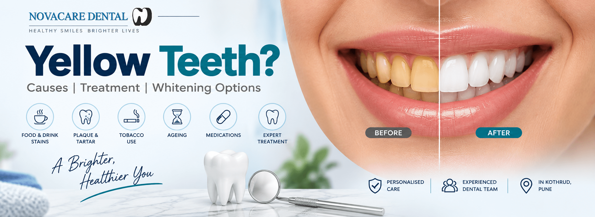 Yellow teeth treatment and teeth whitening at Novacare Dental in Kothrud Pune