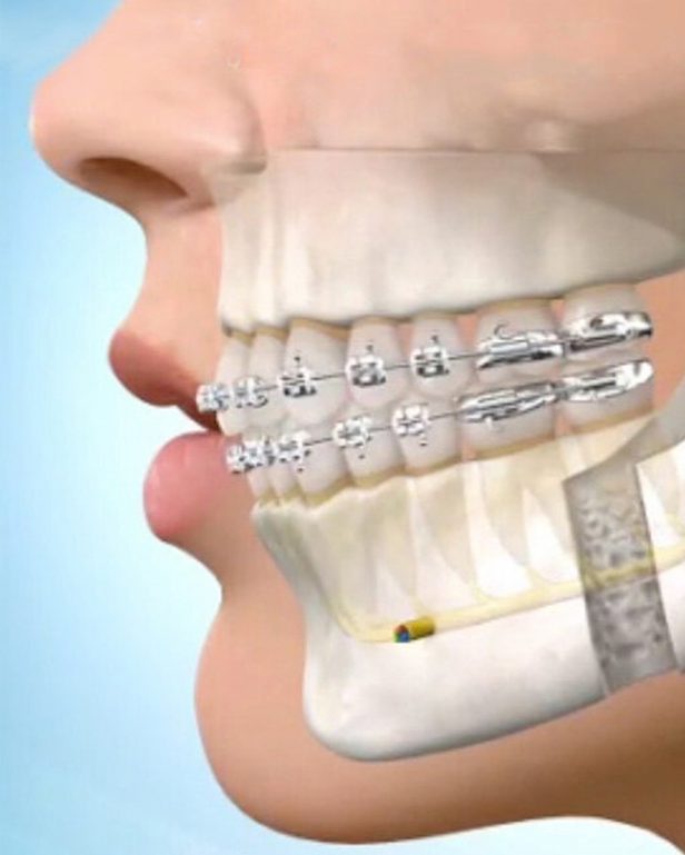 Orthodontic Treatment in Bavdhan