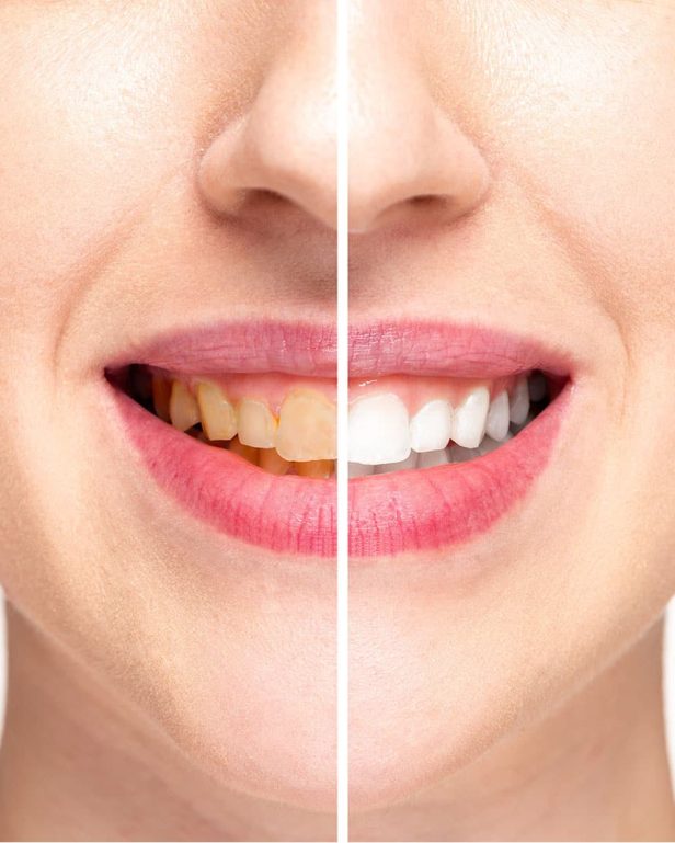 novacare dental clininc smile makeover Smile Makeover Treatment in Karve Road Kothrud